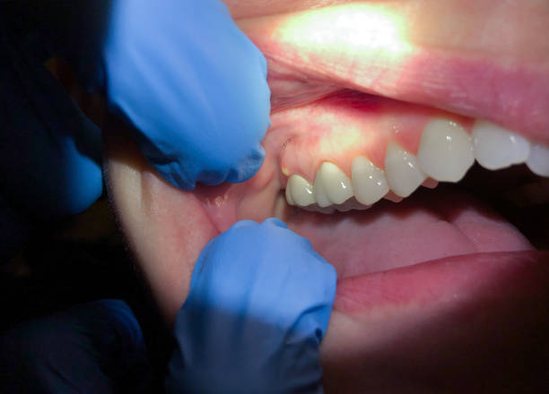 Best Emergency Root Canal Treatment in Smithville, MO