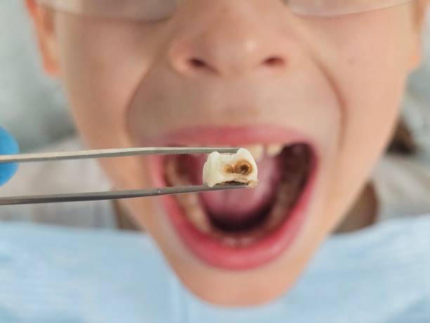 Best Emergency Root Canal Treatment in Smithville, MO